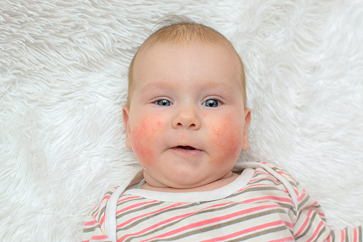 Alergia ao ovo em bebês