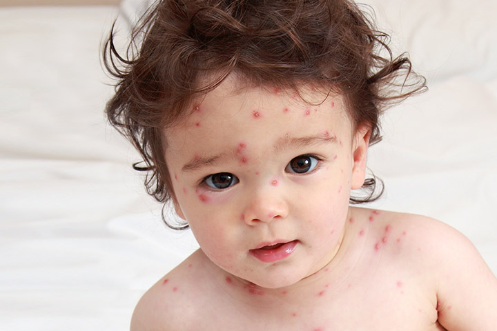 Causas da acne em crianças pequenas