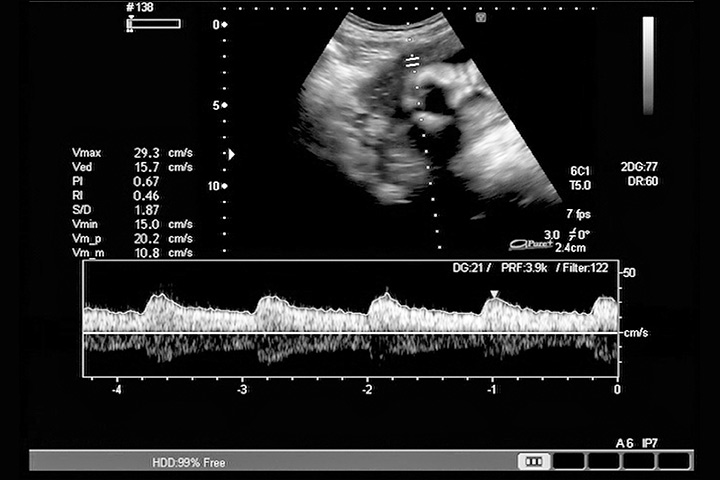 Tabela de batimentos cardíacos fetais semana a semana e métodos usados ​​para controlá-la