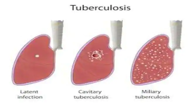 Dia Mundial da Tuberculose 2020: testes de TB que você precisa conhecer