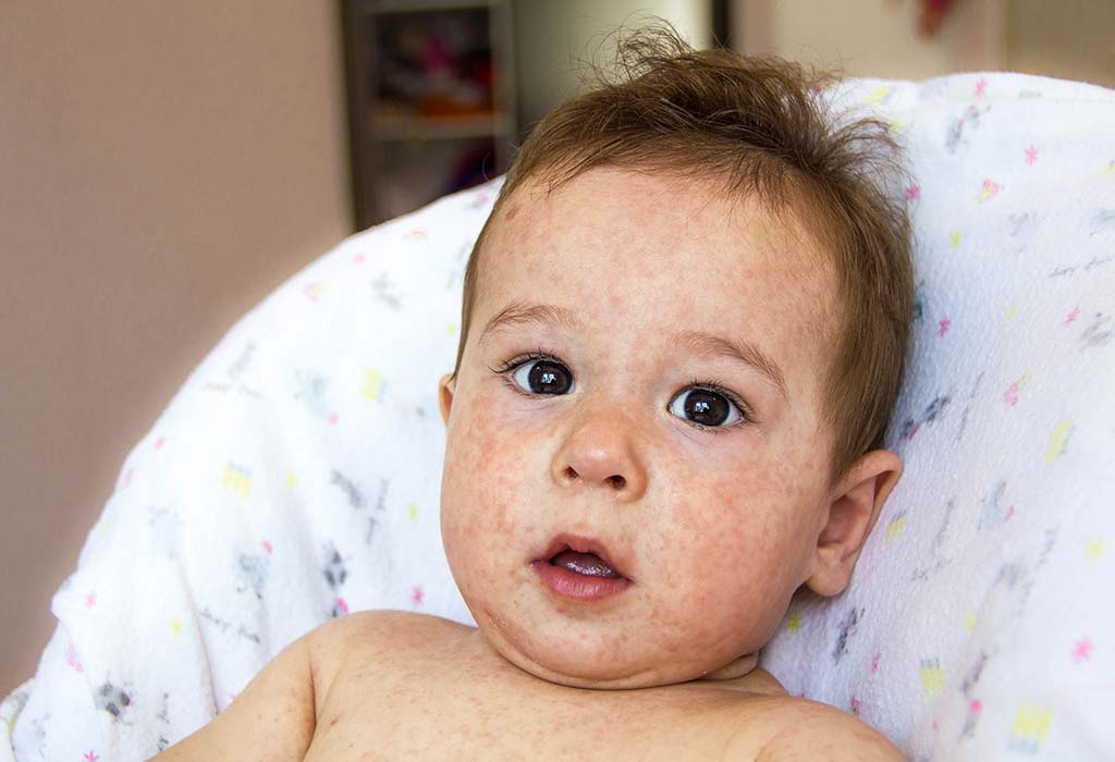 A descoloraÃ§Ã£o da pele em bebÃªs sinaliza um problema grave?